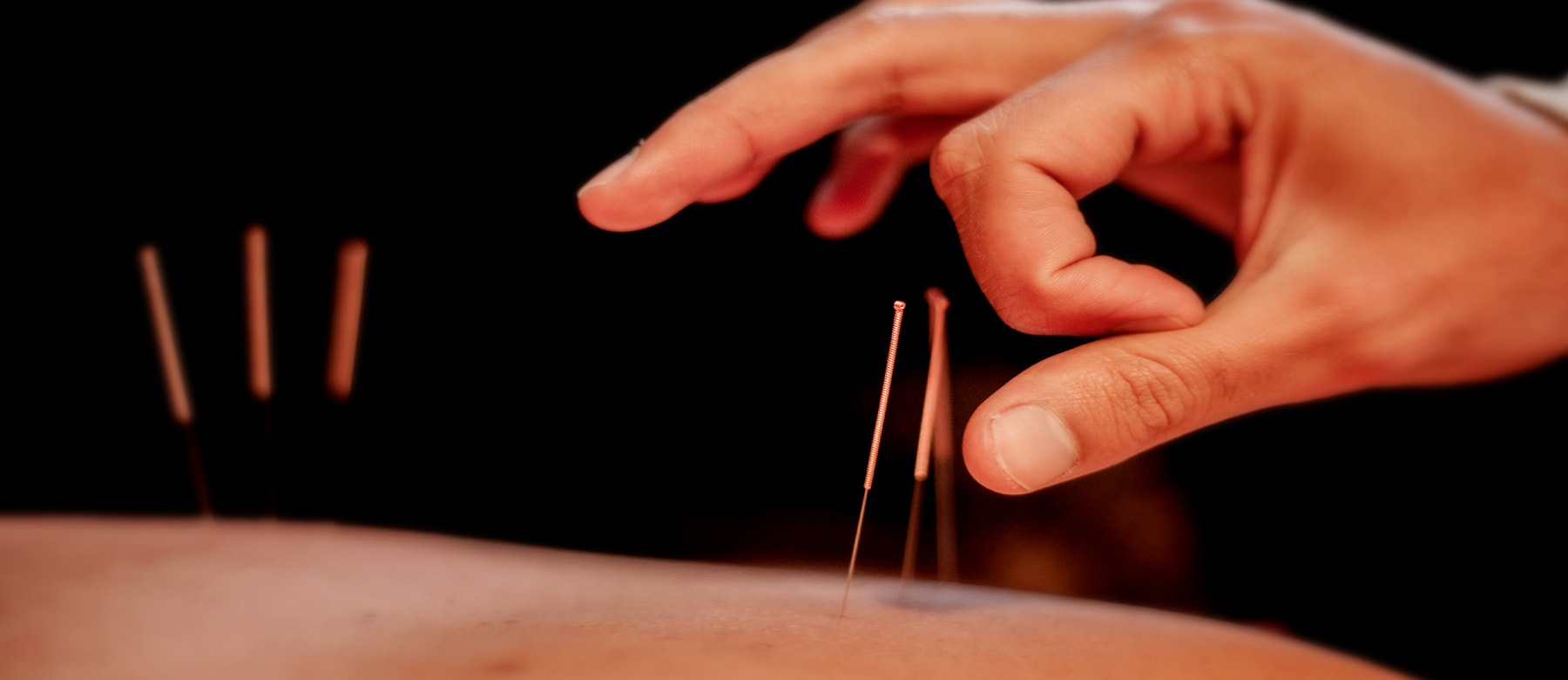 Acupuntura